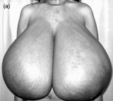 Click to view big image abelena.com_Hypertrophic Breast Case in Iran.jpg